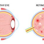 ডায়াবেটিক রেটিনোপ্যাথি: অন্ধত্ব এড়াতে ‘স্ক্রিনিং’ বাড়ানোর তাগিদ
