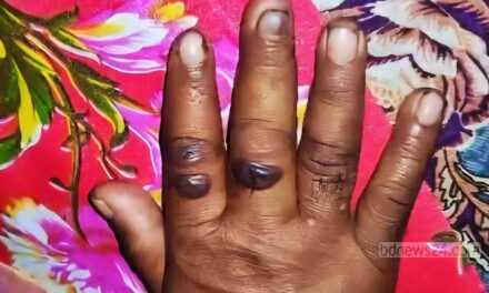 গাইবান্ধায় রোগাক্রান্ত গরু কাটাকাটি করা ১১ জনের দেহে ‘অ্যানথ্রাক্স উপসর্গ’